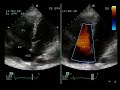 Atrial Septal Defect in an Old Lady