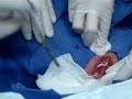 Abscess lanced pt 2
