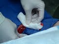 Abscess lanced pt 2 Abscess lanced pt 2