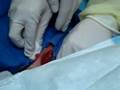 Abscess lanced pt 2