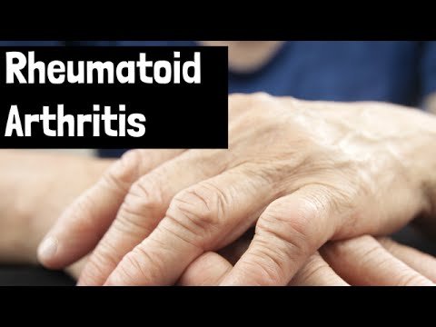how to treat rheumatoid arthritis