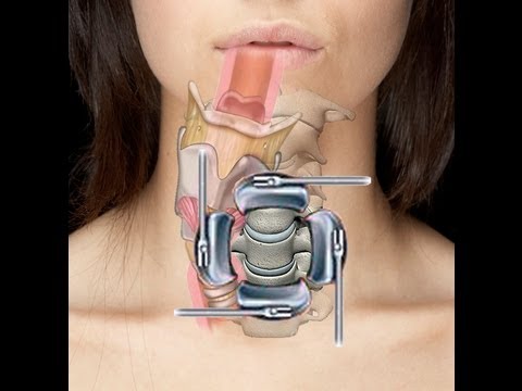 Cervical Spine Surgery (ACDF) - Swallow and Voice Implications