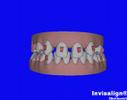 Invisalign Plan