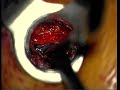 Discectomy Discectomy