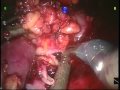 Complication After Nephron Saving Procedure-Robotically Assissted And Laparoscopic. Complication After Nephron Saving Procedure-Robotically Assissted And Laparoscopic.