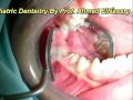 Indications of General Anaesthesia in Pediatric Dentistry