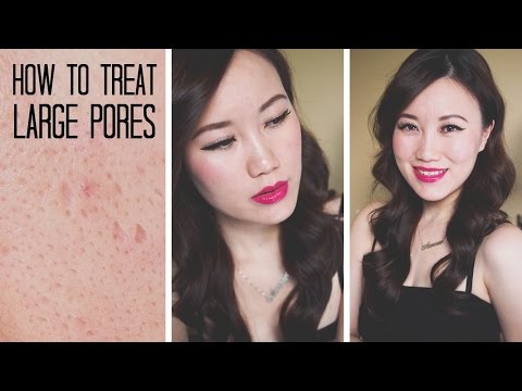 Beauty Guide: Treating Large Pores (Post Acne etc)