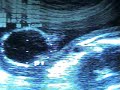 EMBARAZO 16 SEMANAS - GESTATION 16 WEEKS, Premature Rupture Membranes