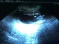 EMBARAZO 16 SEMANAS - GESTATION 16 WEEKS, Premature Rupture Membranes
