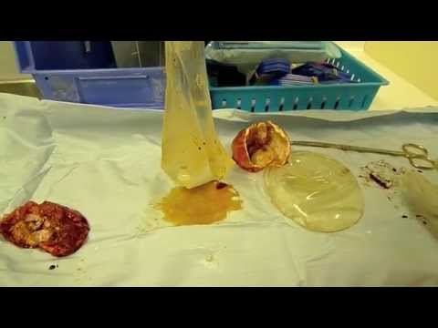 how to detect a breast implant leak