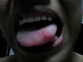 Bleeding Tongue