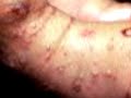 scabies EEEEEEWWWWW Scabies