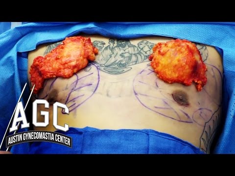 how to remove gynecomastia