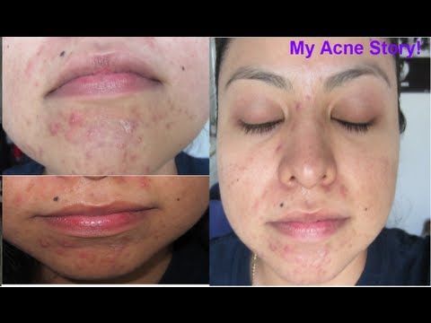 My Acne Story: Birth Control Pills, Antibiotics, Retinol...