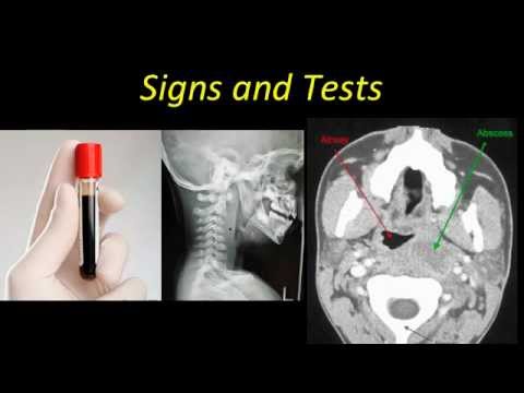 how to drain retropharyngeal abscess