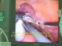ヴィスット医学博士による全腹腔鏡下子宮全摘術（腹腔鏡による子宮･卵巣摘出）
