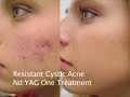Laser Acne Treatment
