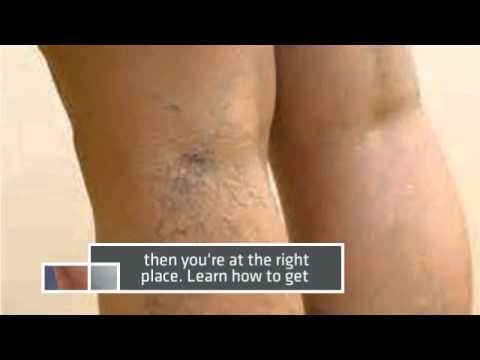 how to eliminate varicose veins naturally