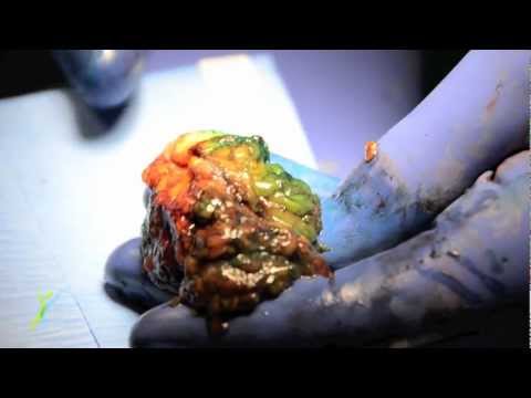 how to perform lymph node biopsy