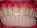 Cosmetic Dentistry Implant Full Mouth Rehabilitation