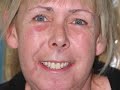 Cosmetic Dentistry Implant Full Mouth Rehabilitation