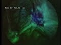 Autofluorescent Laparoscopy Diagnosis of Endometriosis