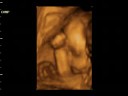 Dzaky Mom 6 Month Pregnant   4 Dimension UltraSonoGraphy 1 Ultrasonography