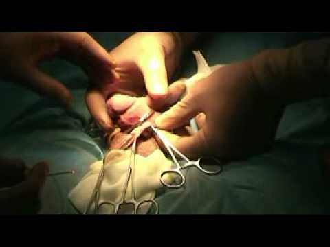 Лазерно обрязване при фимоза, Хил клиник Laser Circumcision