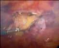 Laparoscopic-ventral