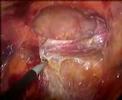 Laparoscopic ventral hernia repair (TAPP) Laparoscopic Hernia Repair