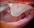 Laparoscopic ventral hernia repair (TAPP)