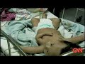 baby born with 3 arms baby born with 3 arms