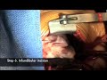 DCRV repair, Double Chambered Right Ventricle DCRV repair, Double Chambered Right Ventricle