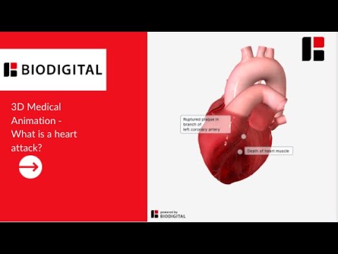 3D Medical Animation - What Is A Heart Attack?
