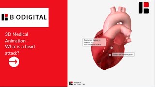 3D Medical Animation - What is a Heart Attack?