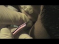Nastiest Cyst Removal EVER from Robs Ear!!!