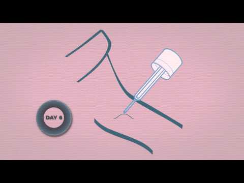 how to cure molluscum contagiosum