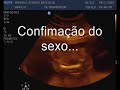 Ultrassom de 21 semanas do Pedro Henrique