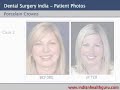 Porcelain Crowns Porcelain Crowns