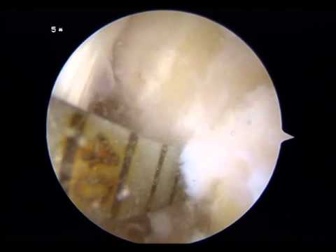 how to repair mcl