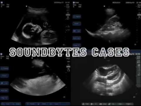 how to measure aorta on ultrasound