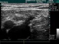 Saphenous Vein Outlet In Usg Exam Saphenous Vein Outlet In Usg Exam