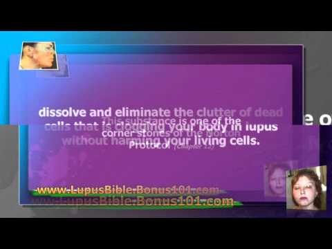 how to relieve lupus joint pain