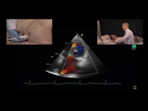 how to measure mr vena contracta