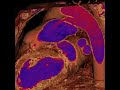 CT Angiography Champion Swimmer Congenital Heart Disease Angiography