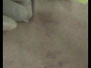 Sclerotherapy Sclerotherapy