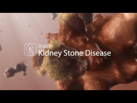 Medical Animation: Kidney Stone Disease