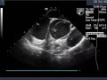 Dissection of Ascending Aorta on Echocardiogram