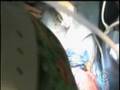 Miracle Baby Born Twice (CBS News)