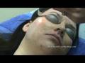 Laser Skin Resurfacing for Acne Scars